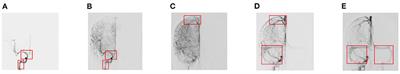 Temporal-Spatial Feature Extraction of DSA Video and Its Application in AVM Diagnosis